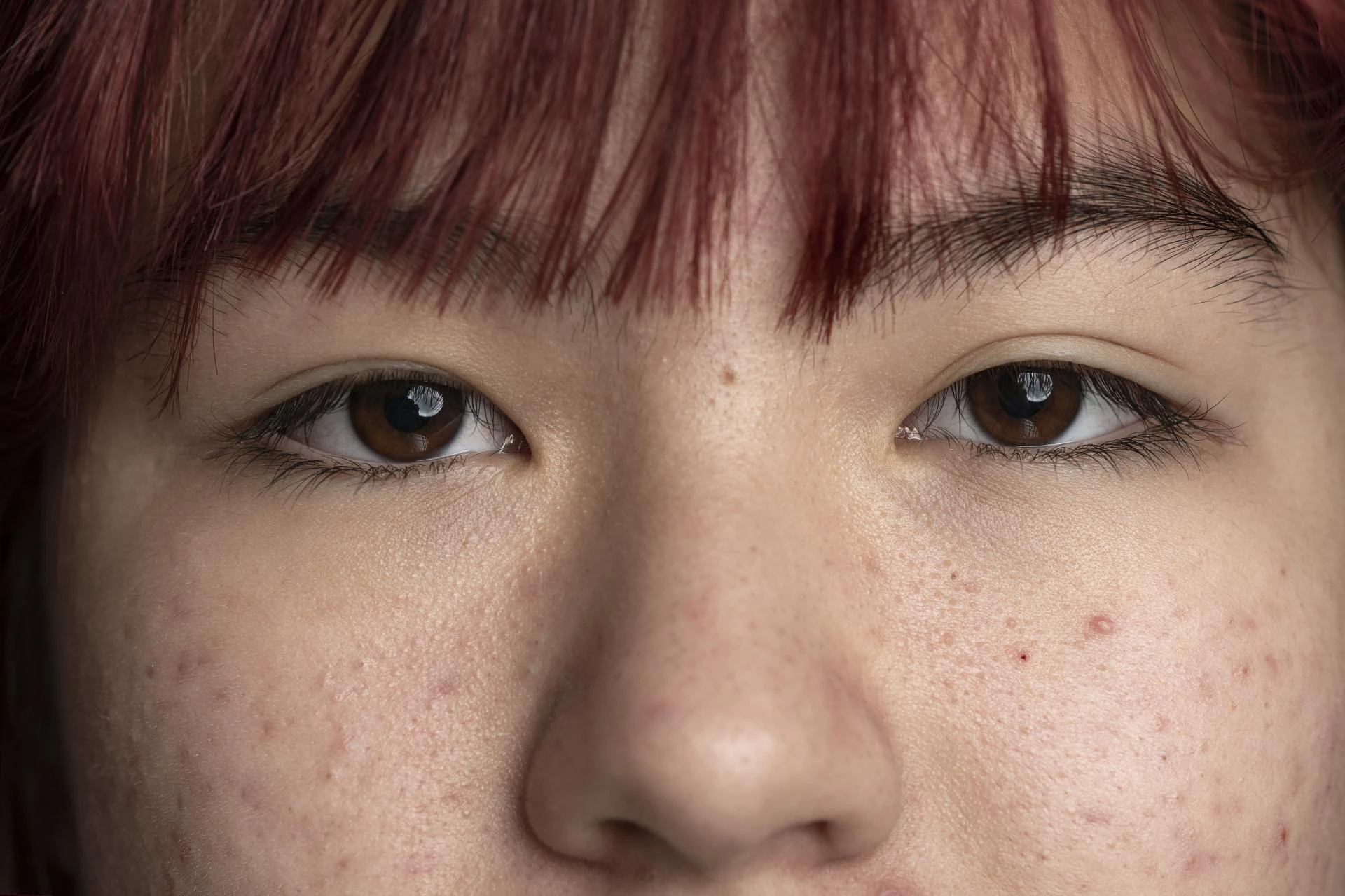 The Aluer Advantage: Why Choose Us for Acne Scar Treatment in Calicut ?