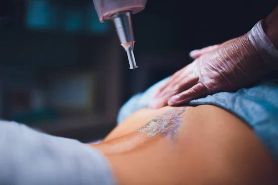 Tattoo Removal in Birmingham: What You Need to Know Before Your First Session