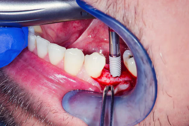 How a Root Canal Can Save Your Tooth and Your Smile