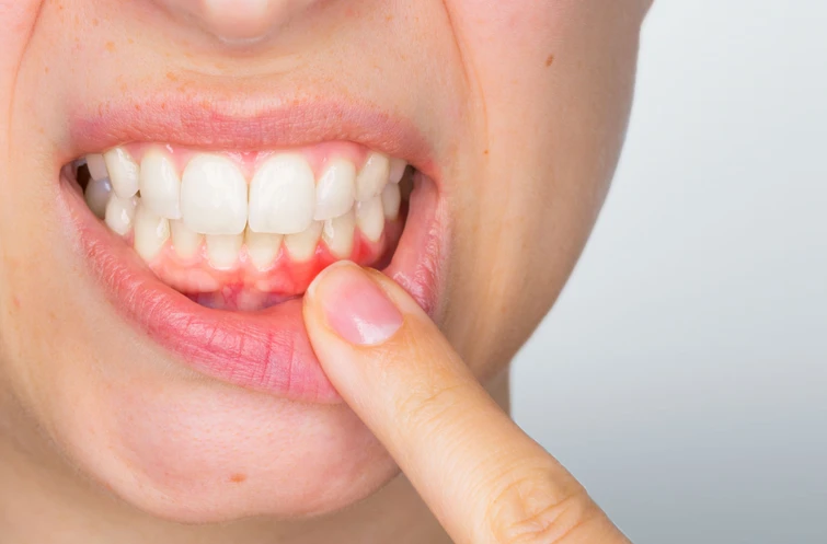 What Causes Gum Disease and How to Treat It Effectively