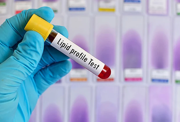 Comprehensive Guide to Lipid Test in Dombivli East – Importance and Benefits