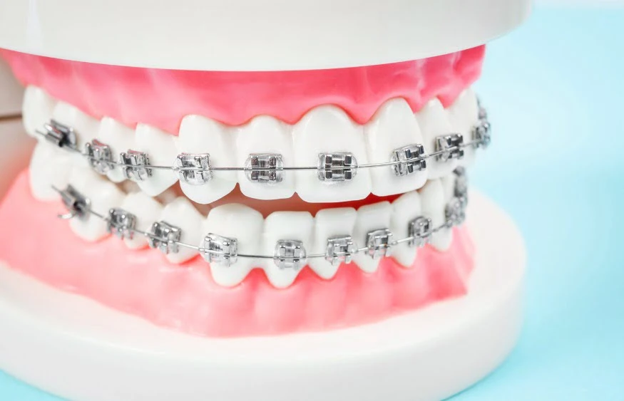  Caring for Your Braces: Tips for a Smooth Journey