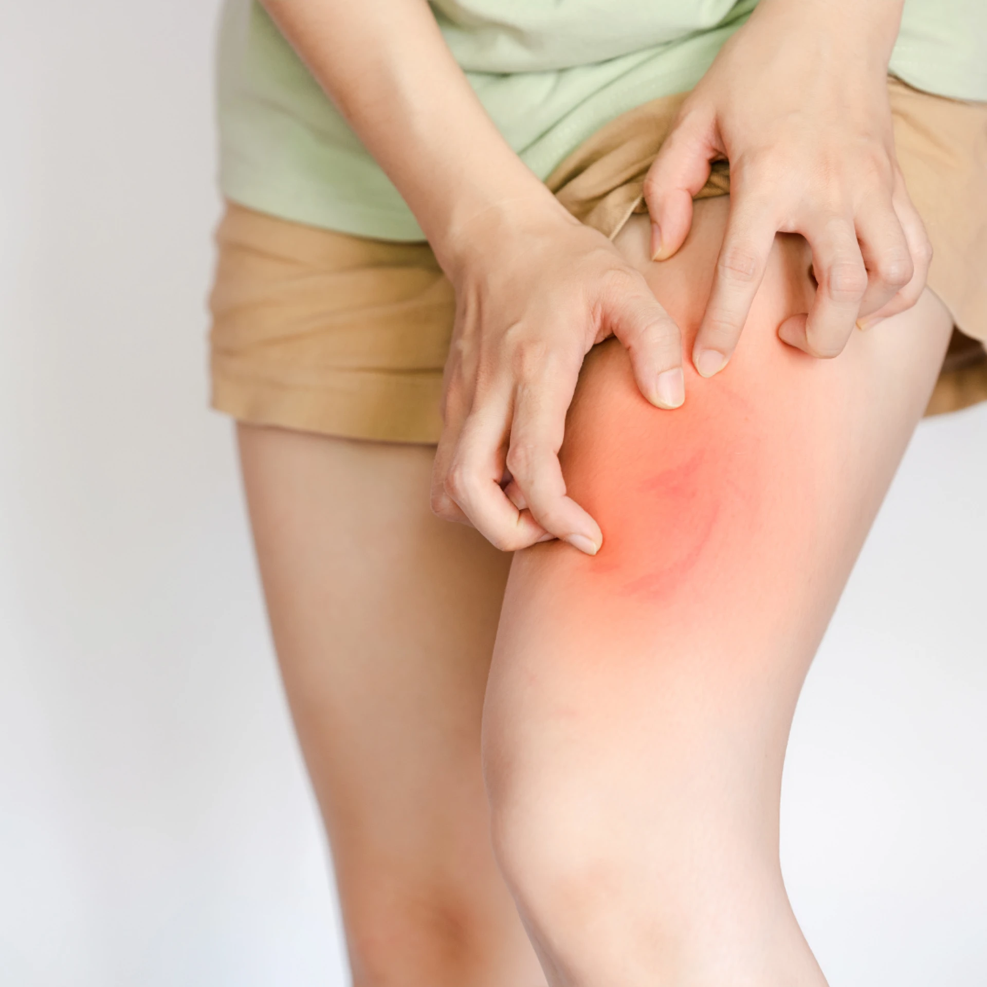 Can Skin Allergies Be Prevented?