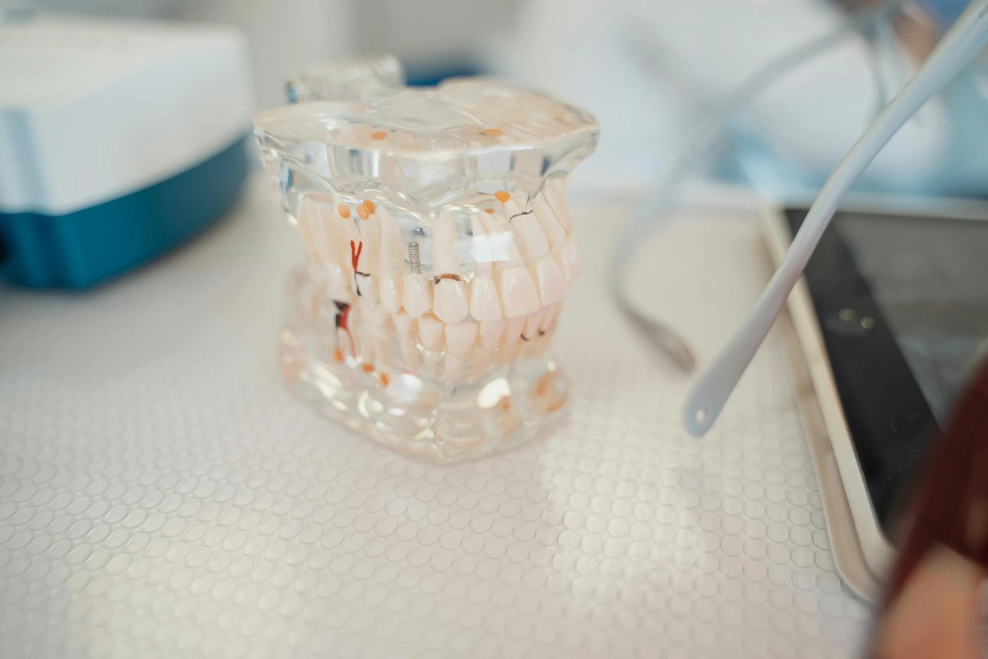 8 Tips for Safely Healing Your Dental Implants