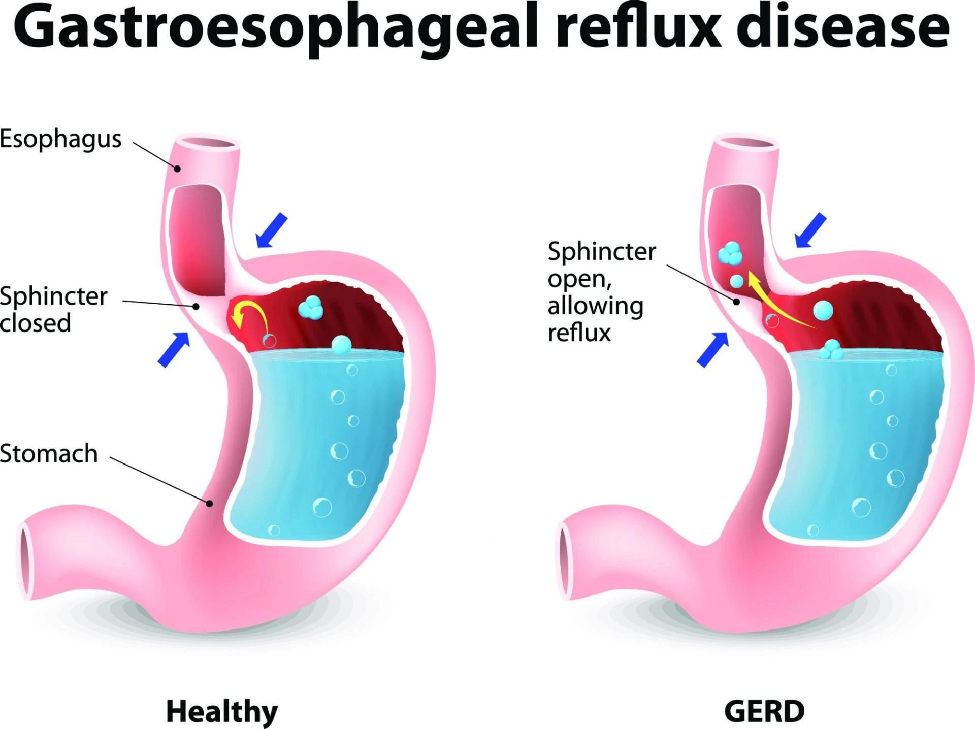Everything You Need to Know About Hiatus Hernia Surgery in Sydney
