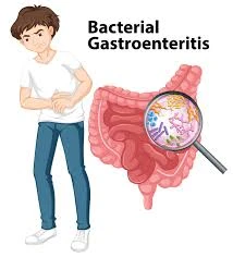 Gastroenteritis: Causes, Prevention, and Treatment