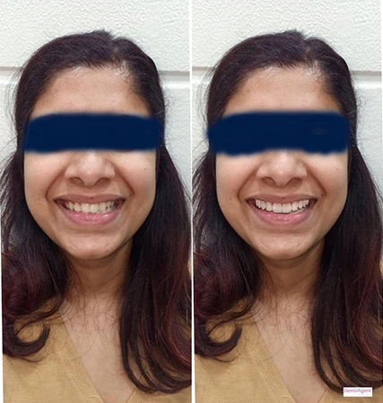 Achieve a Perfect Smile with the Best Implant Dentist in Bhoiwada