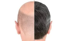 Understanding FUE Hair Transplant in Dubai: Benefits & Costs