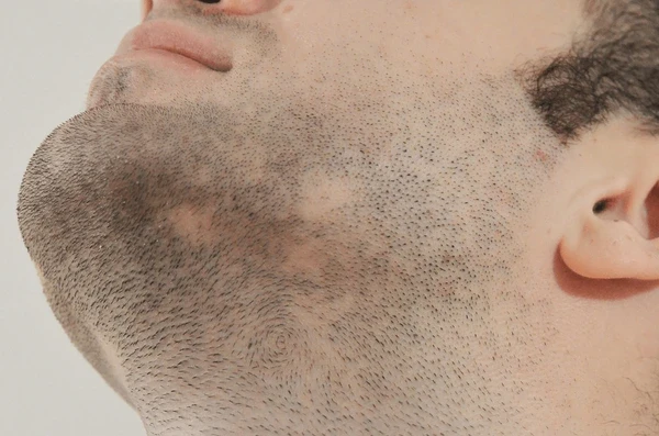 Best Beard Hair Transplant Clinic