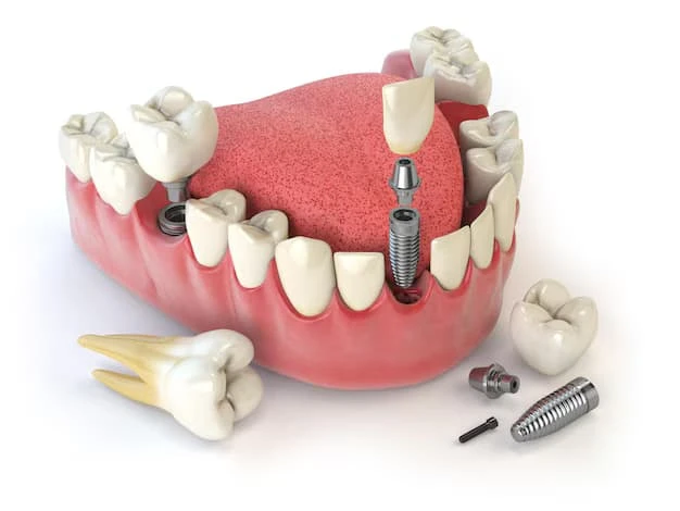 What to Expect: 5 Steps to Getting Dental Crowns Near Me