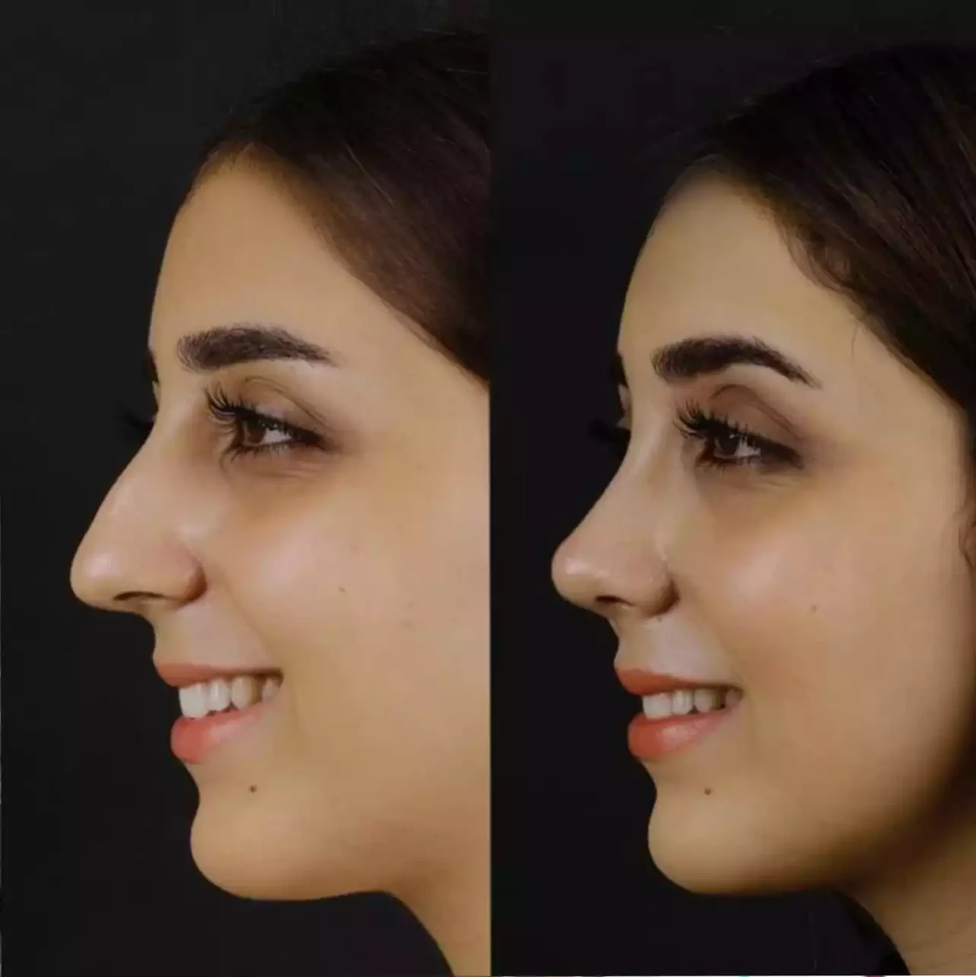 Where Do the Best Septoplasty Surgeons in Dubai Practice?