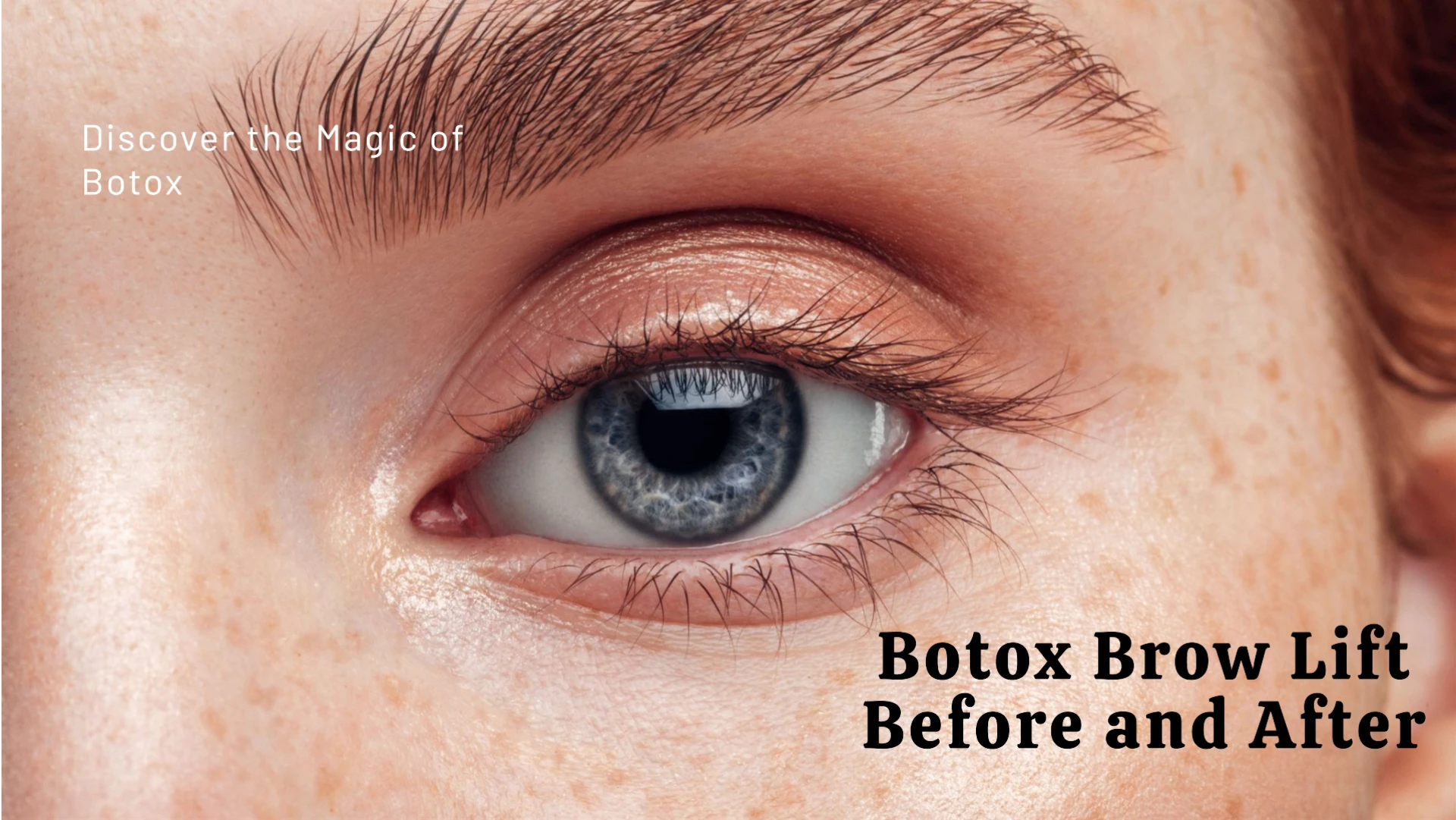 Botox Brow Lift Before and After