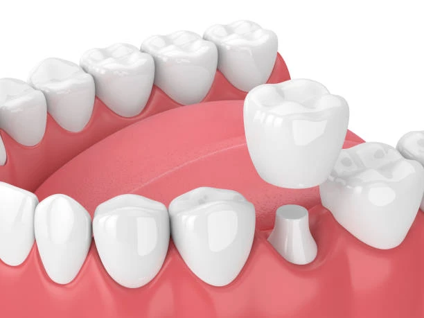 Dental Crowns in Converse, TX: A Complete Guide to Restoring Your Smile