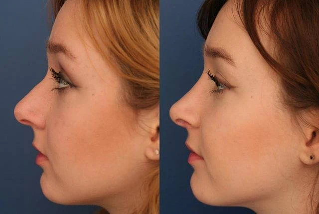 Achieve the Ideal Nose: Premier Rhinoplasty Services in Riyadh