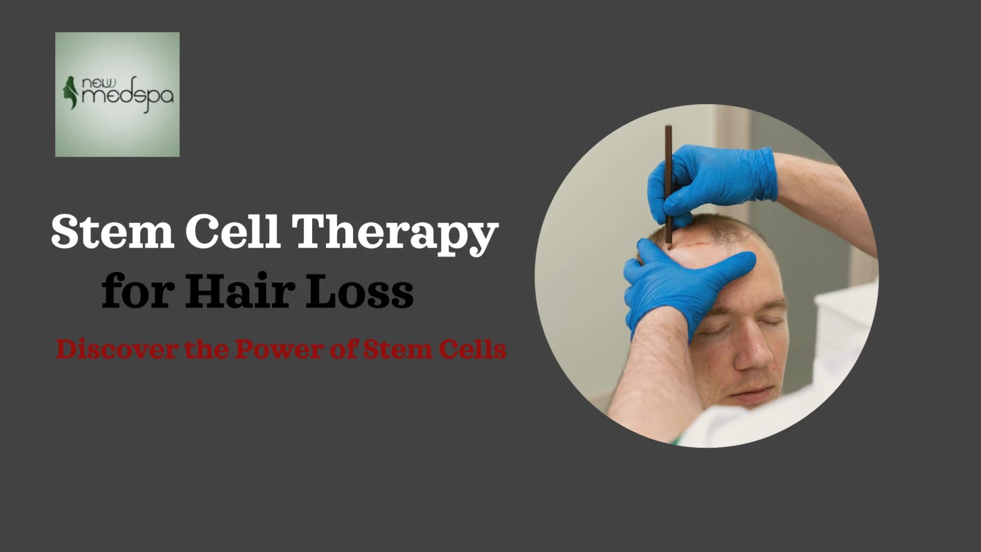 Stem Cell Therapy for Hair Loss