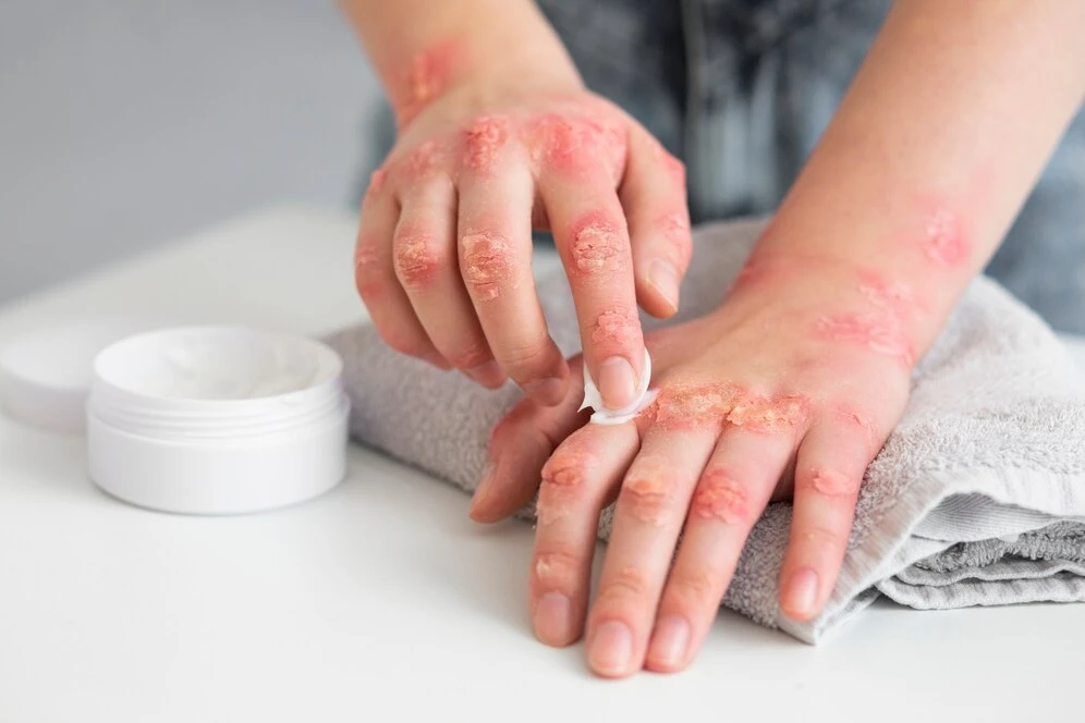How does stress affect eczema, and what are some ways to manage it?