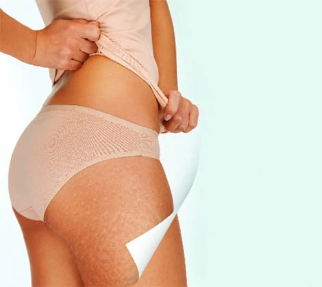 Is Cellulite Holding You Back? Here’s How to Get Rid of It!