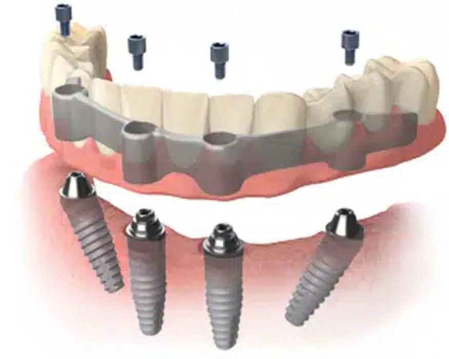 How Dental Implants Can Help You Prevent Bone Loss After Tooth Loss?