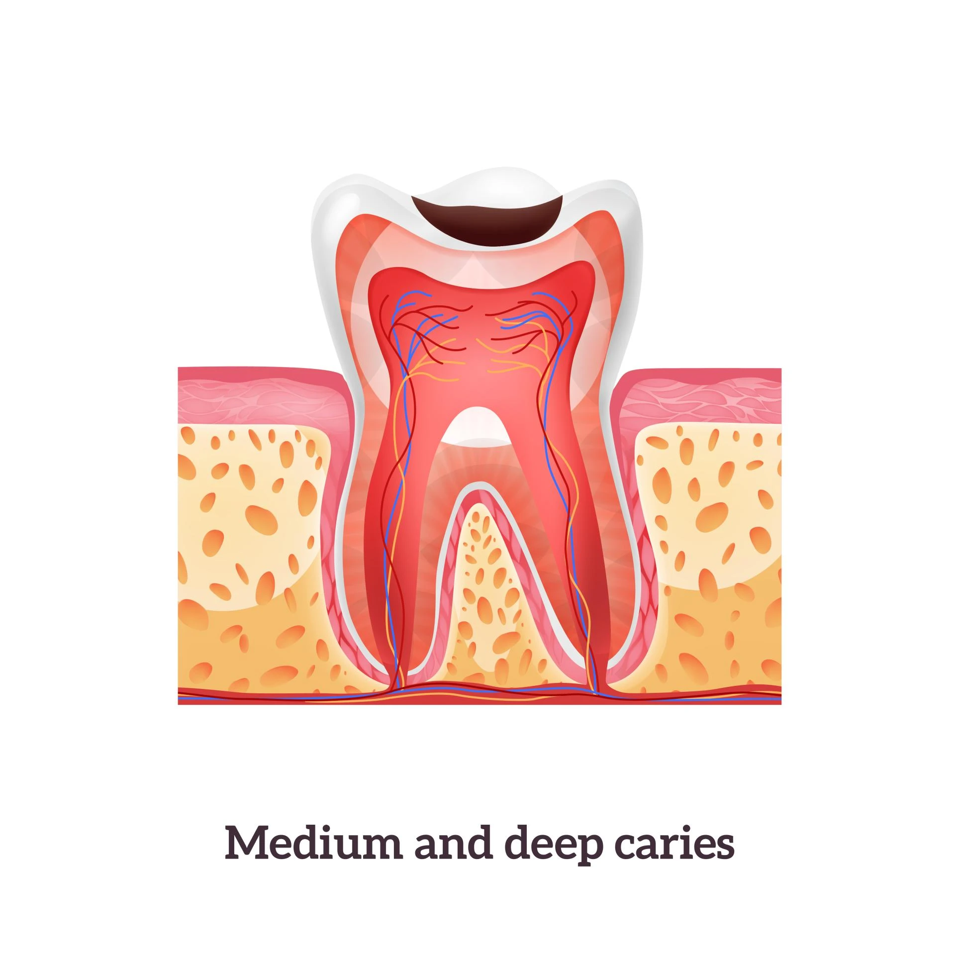Why do most people need a root canal?
