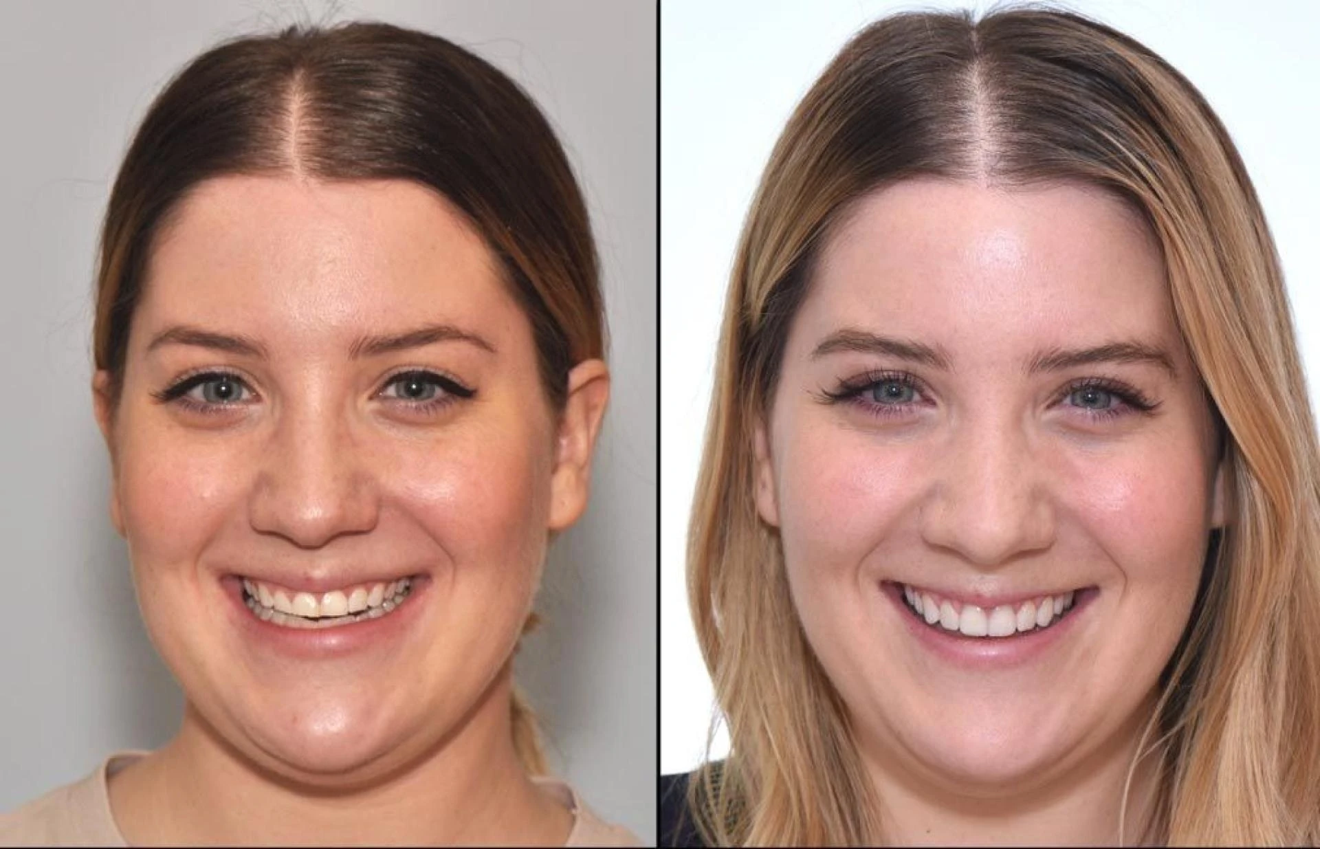 Can Anyone Get Veneers?