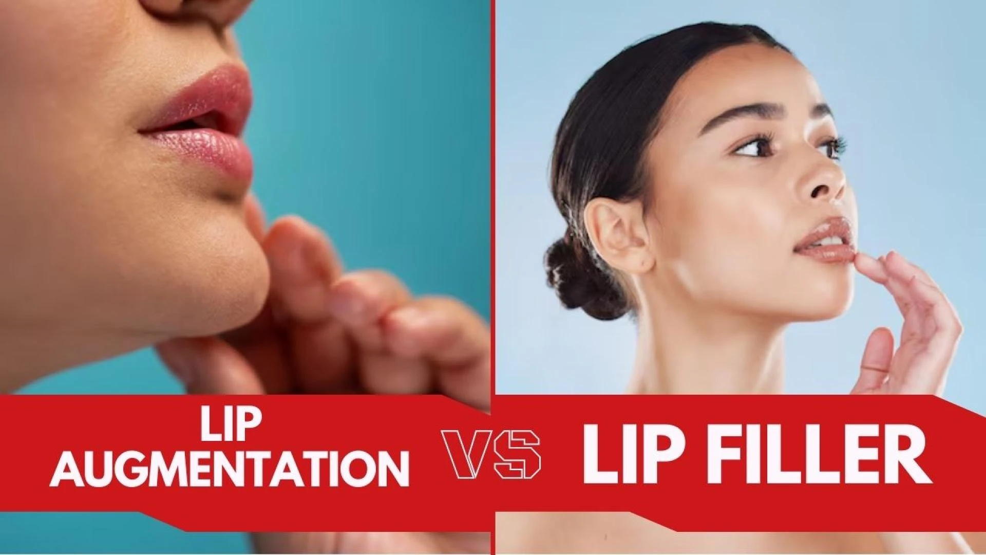 Lip Augmentation vs Lip Filler