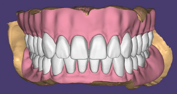 The Future of Denture Design: How Digital Denture Design is Transforming Smiles