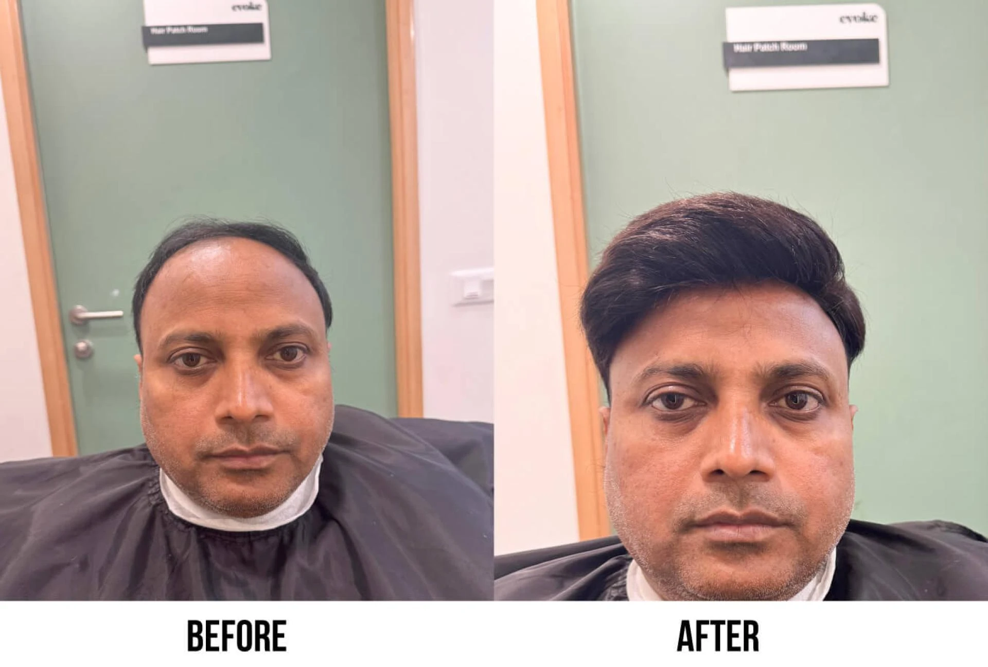 Get Your Confidence Back With the Best Hair Patch Solutions in Delhi & Gurgaon