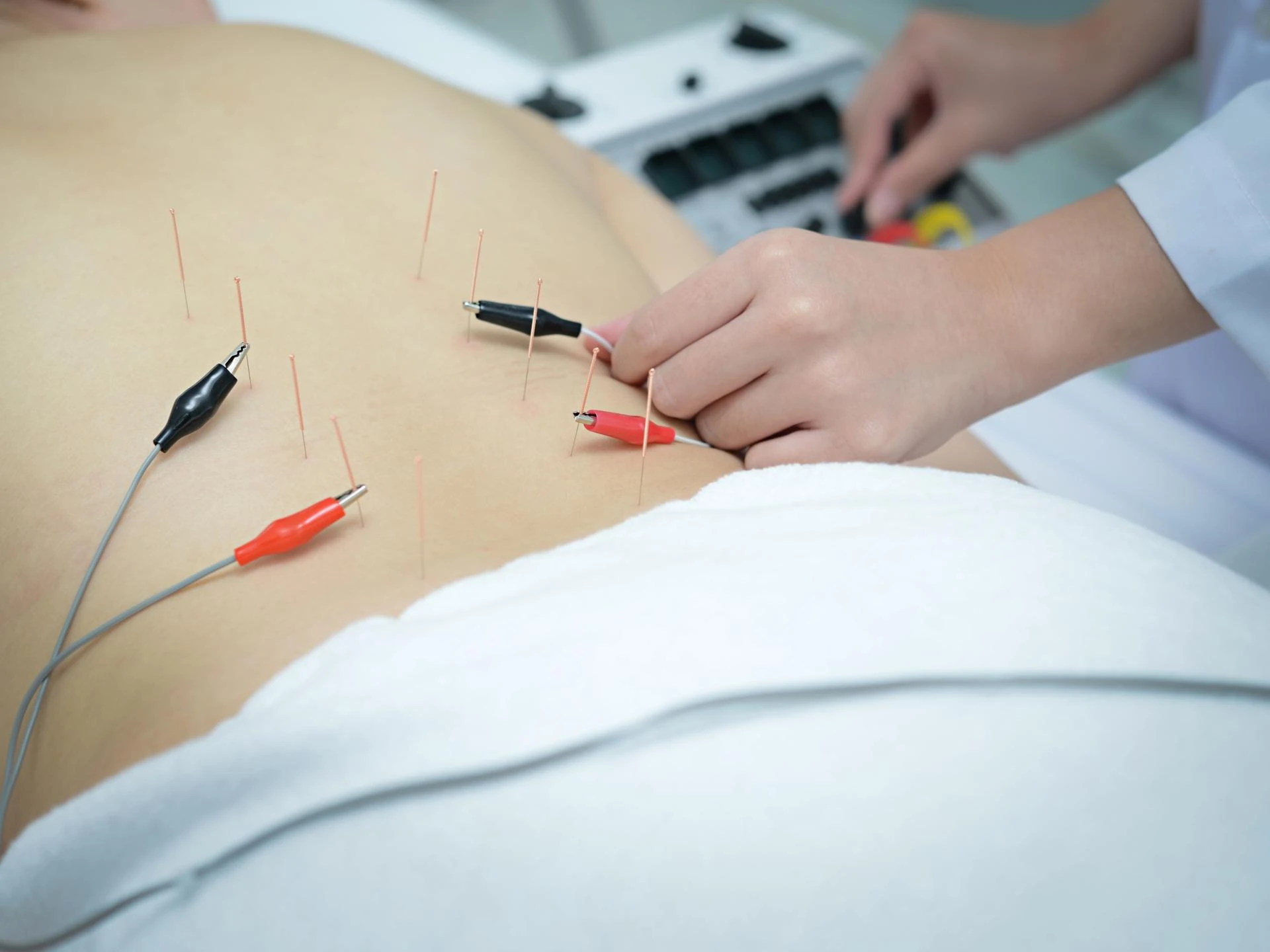 Experience the Best Acupuncturist Services in Olympia, WA with Nature Chi Acupuncture