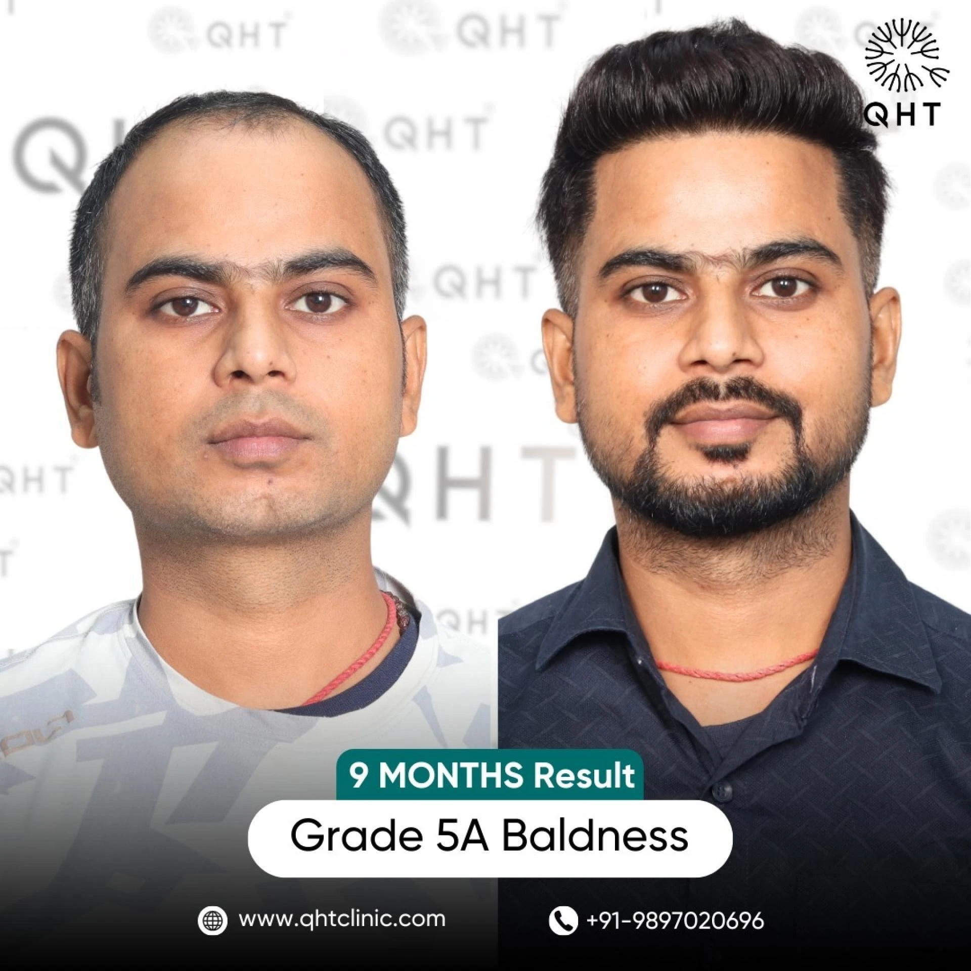 Male Hair Transplant – Regain Your Confidence and hair line