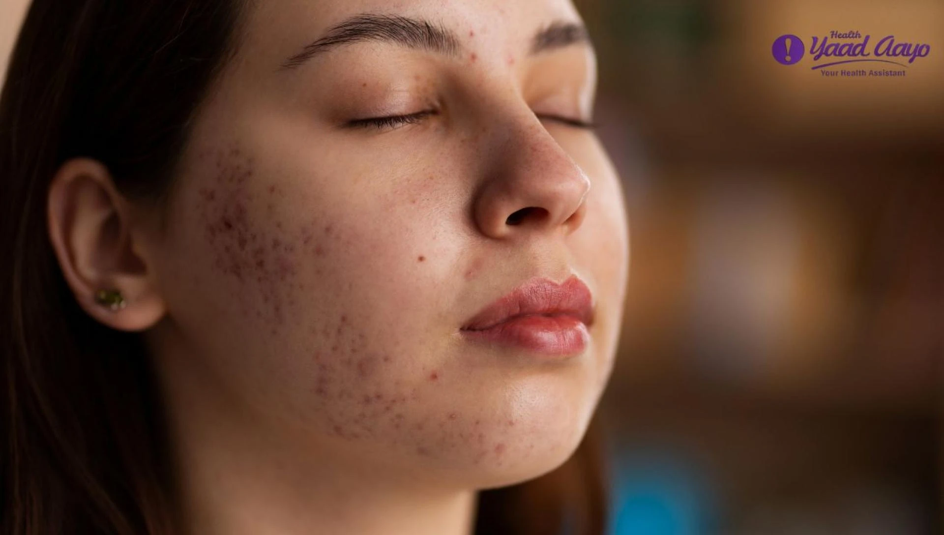 10 Causes of Acne Breakouts in Adults and How to Avoid Them
