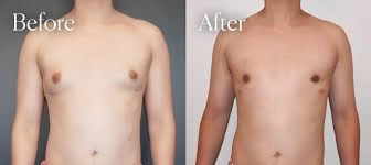 Gynecomastia Surgery in Lahore: The Ultimate Guide to Transforming Your Confidence