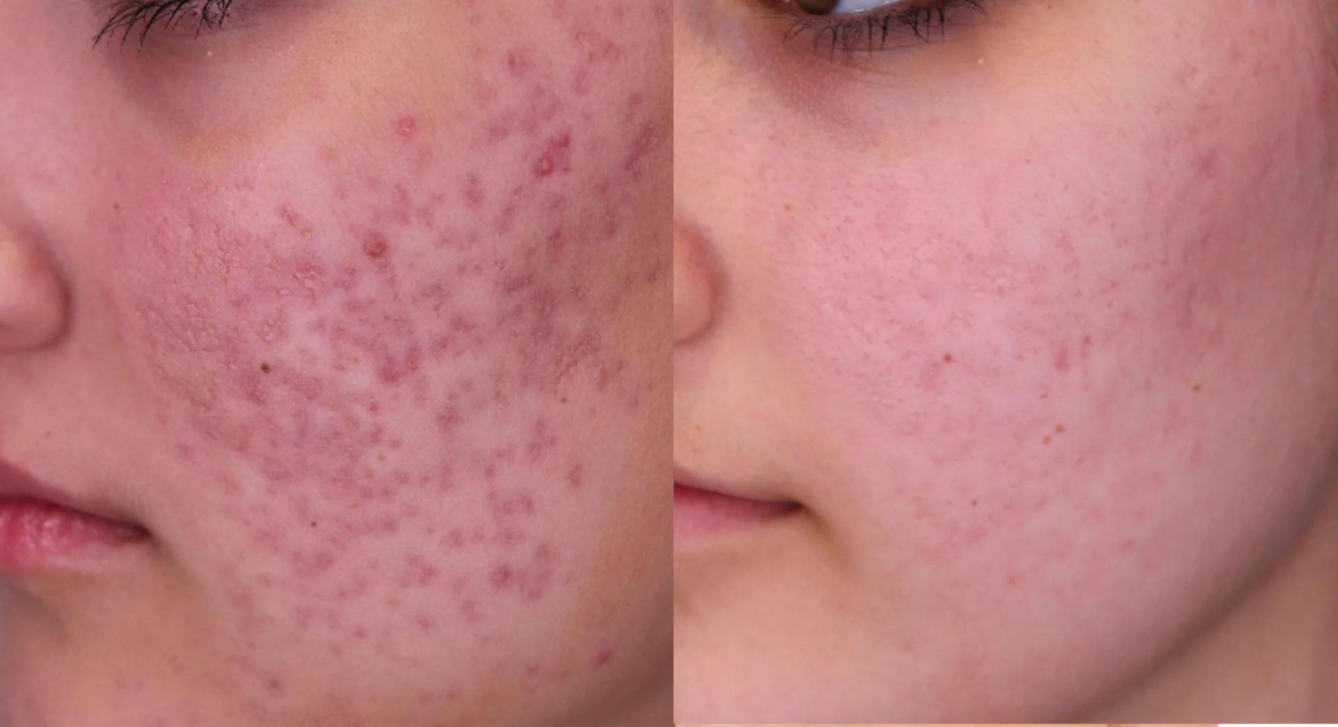 What are the Effective Treatments for Acne Scars?