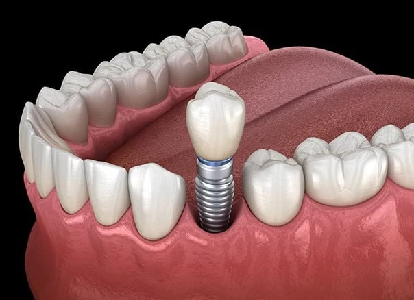 What You Need to Know Before Getting Dental Implants in London