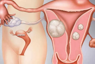 Fibroid Treatment near me