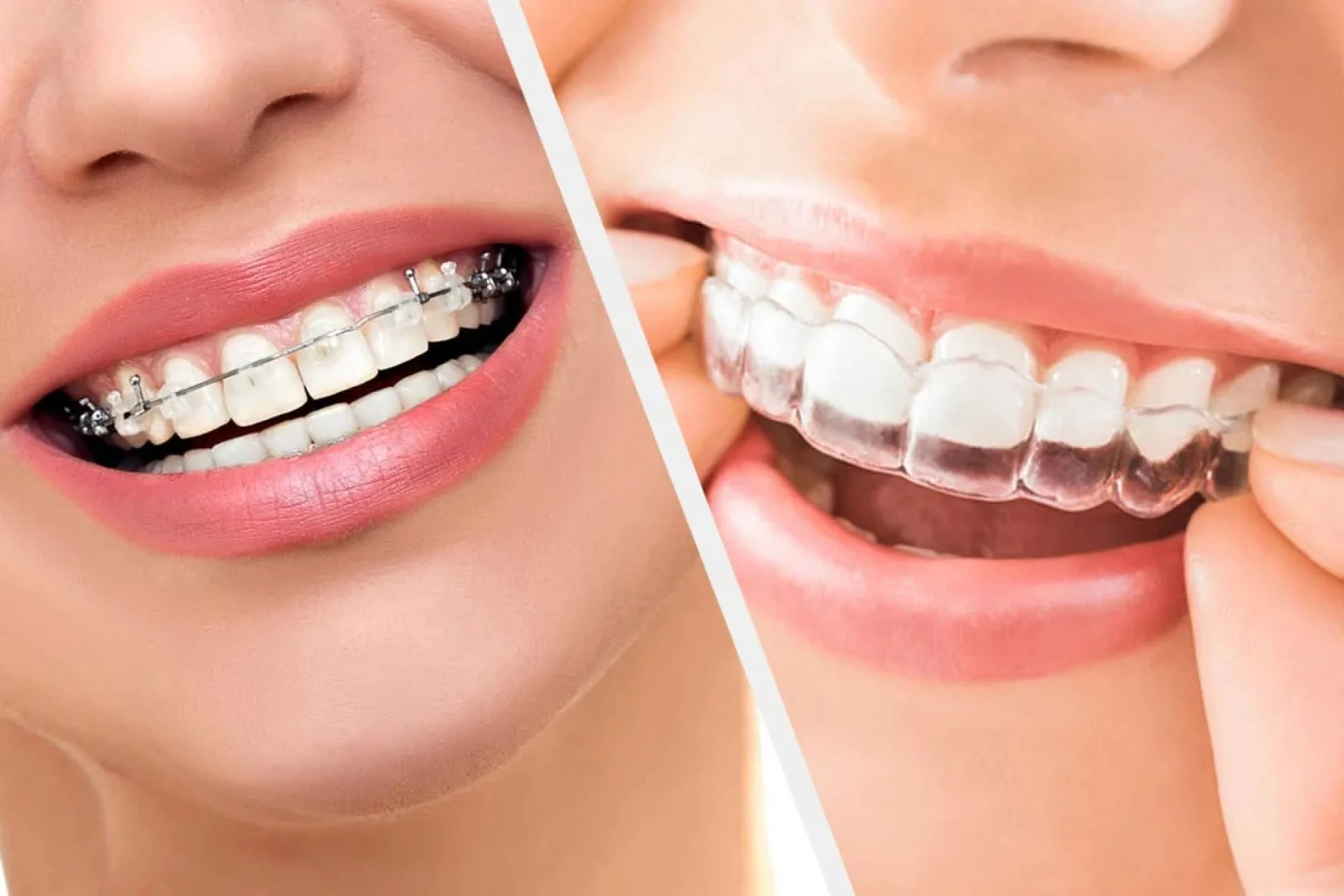 Orthodontic Treatments in RR Nagar