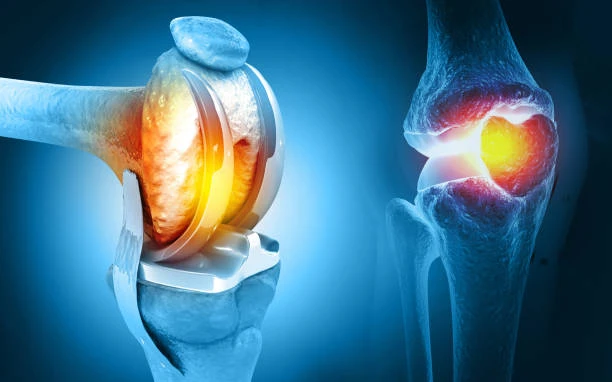 Best Knee Replacement in Lahore – Top Hospitals & Prices