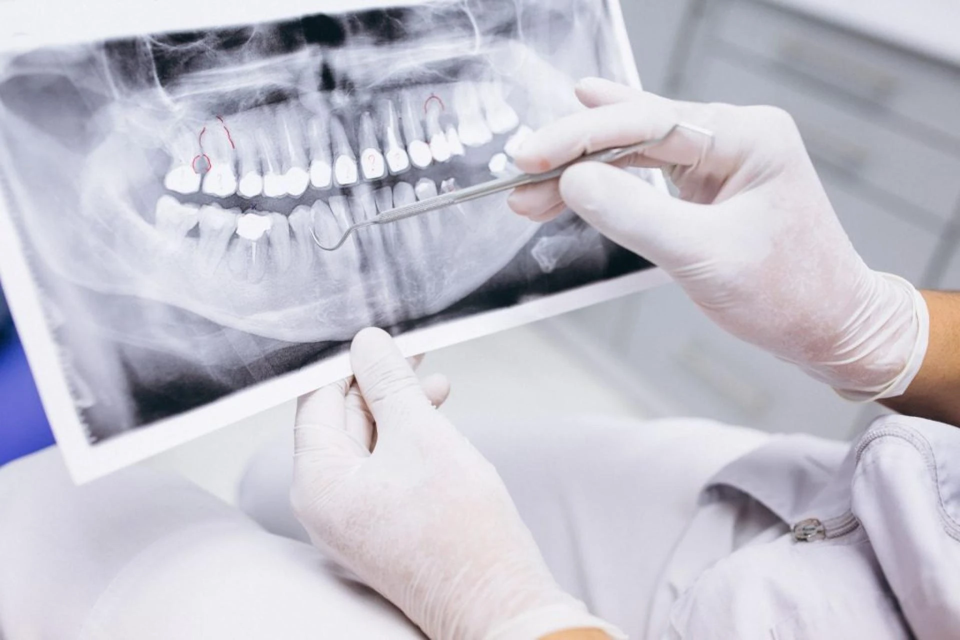 Managing Root Canal Pain: What to Expect After Treatment