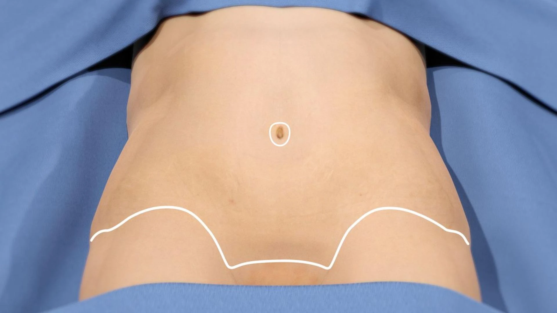 Where to Start When Considering a Tummy Tuck?