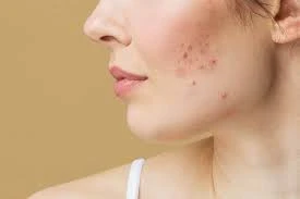 What Advanced Acne Treatments Do Dermatologists in Beverly Hills Use?