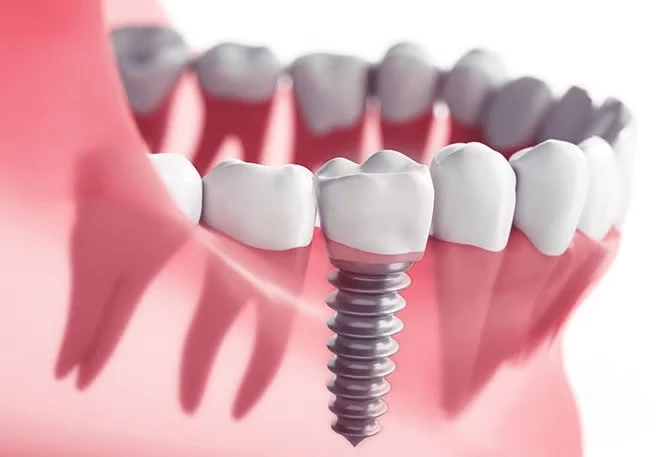 Best Dental Implantologist in RR Nagar