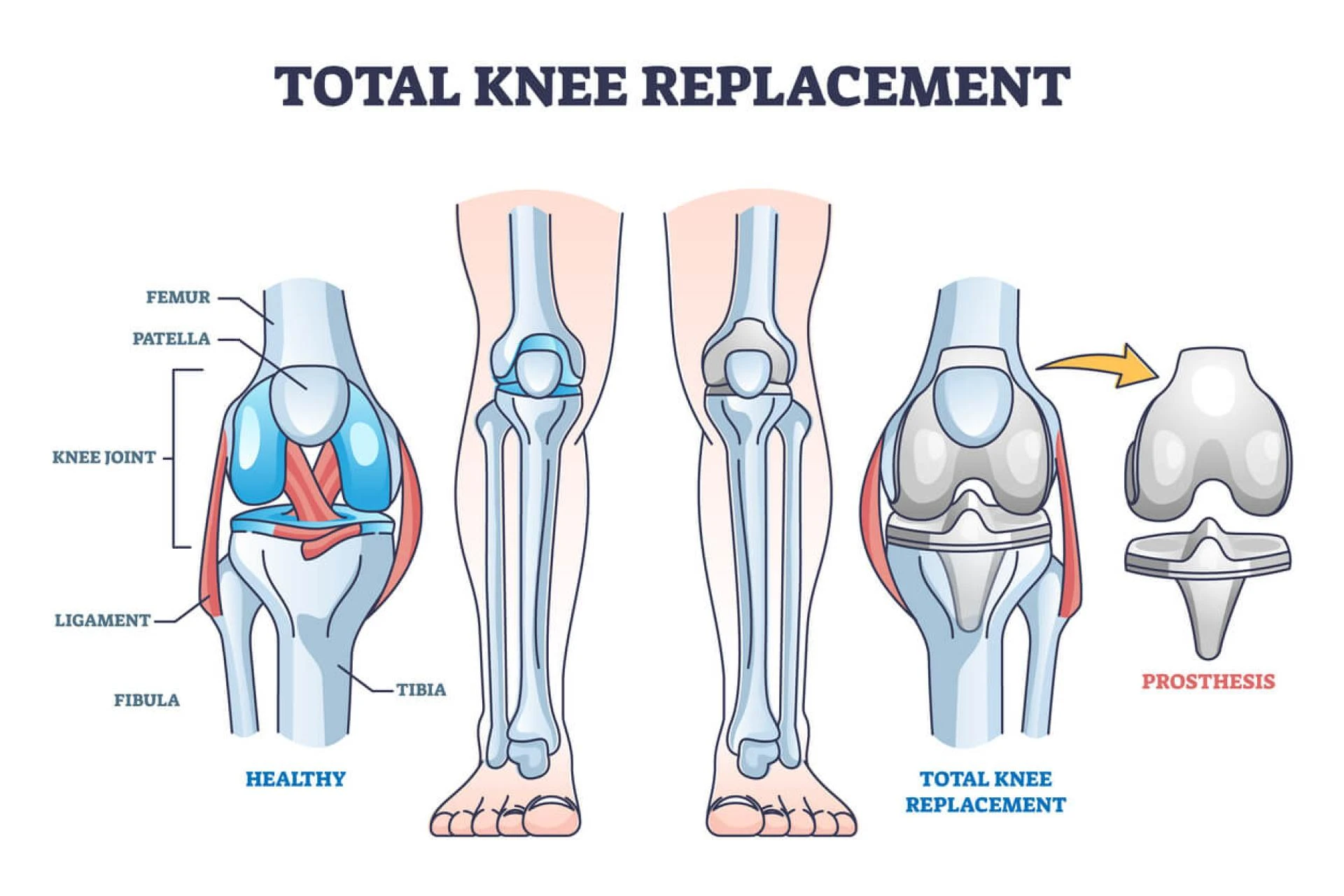 Knee Replacement Surgery Cost Delhi