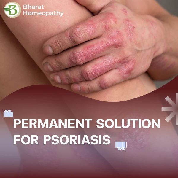 Permanent Solution for Psoriasis: Can Homeopathy Cure It Completely?