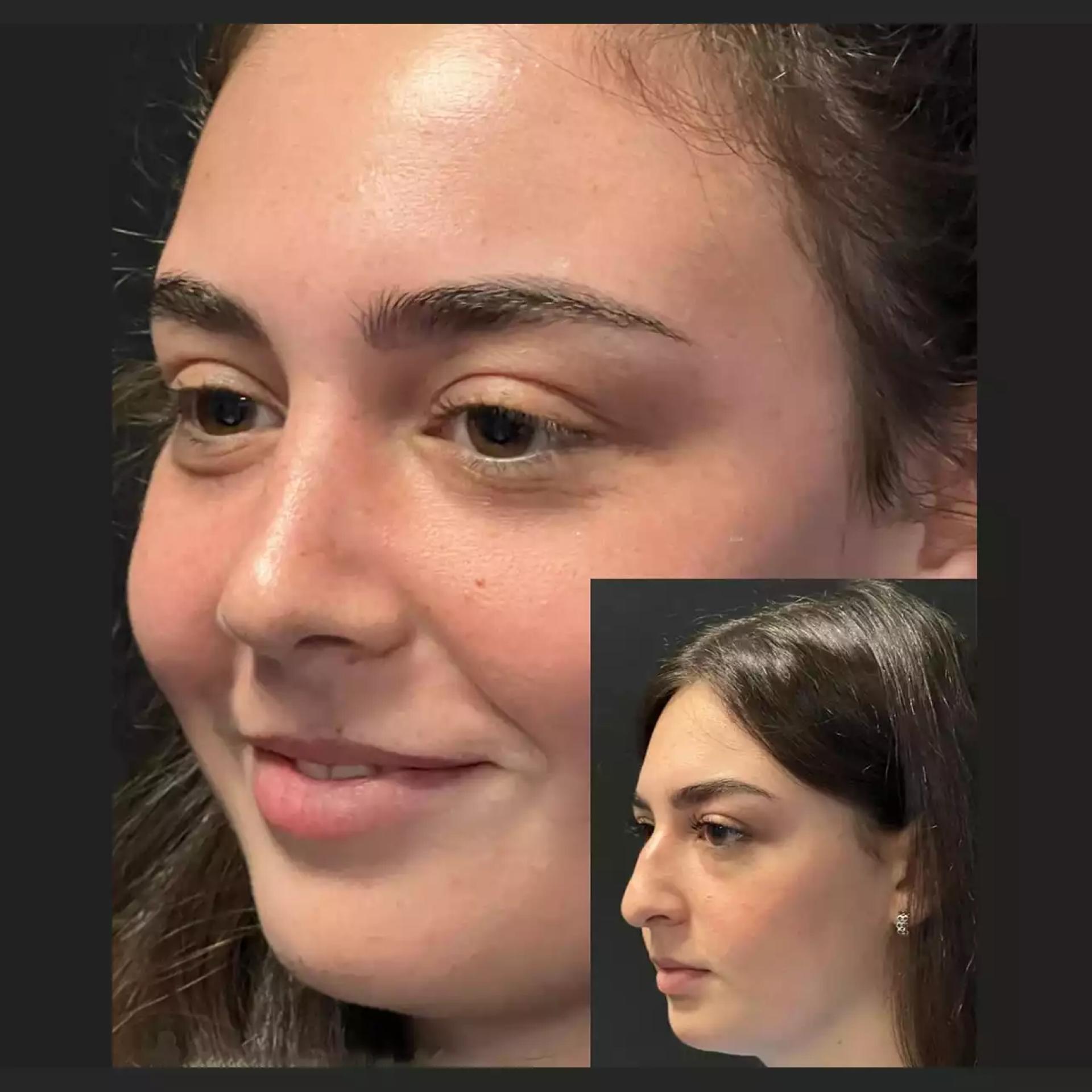 Why the Best Rhinoplasty Surgeons in Dubai Are Preferred Worldwide