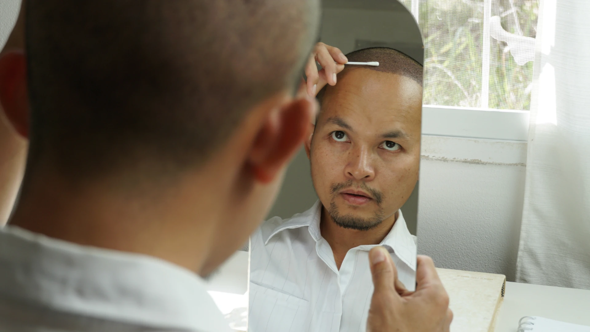Permanent Hair Restoration with FUE Hair Transplant– Safe & Reliable