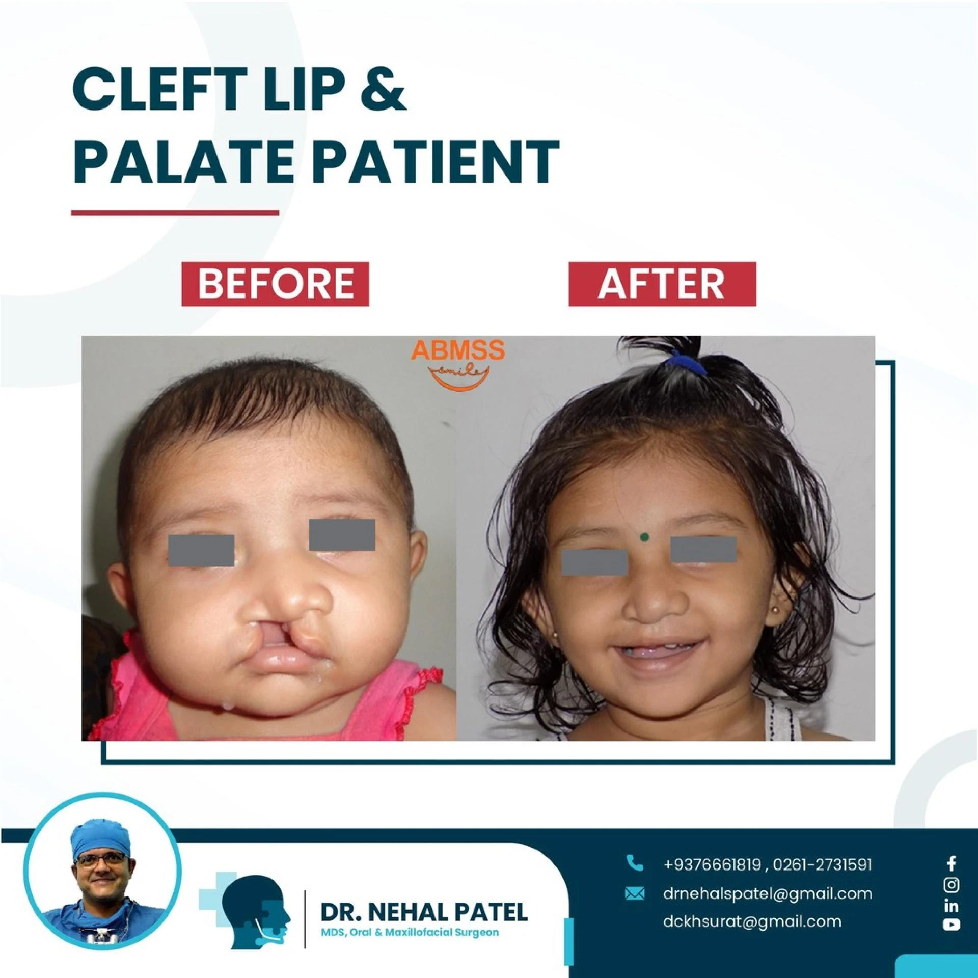 Cleft and Palate Repair Surgery: A Comprehensive Guide for Parents