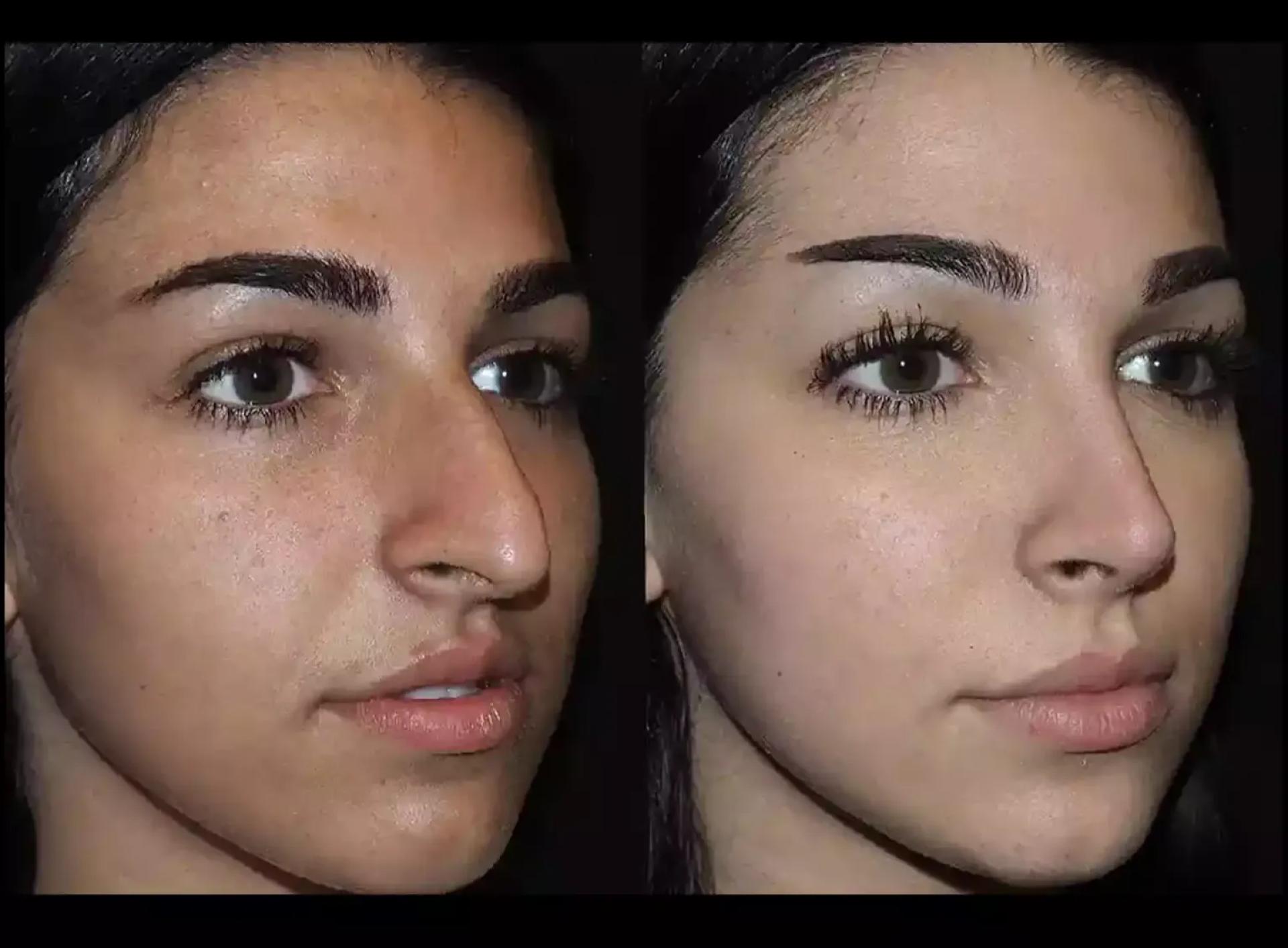 Best Rhinoplasty Surgeons in Dubai: Before and After Transformations