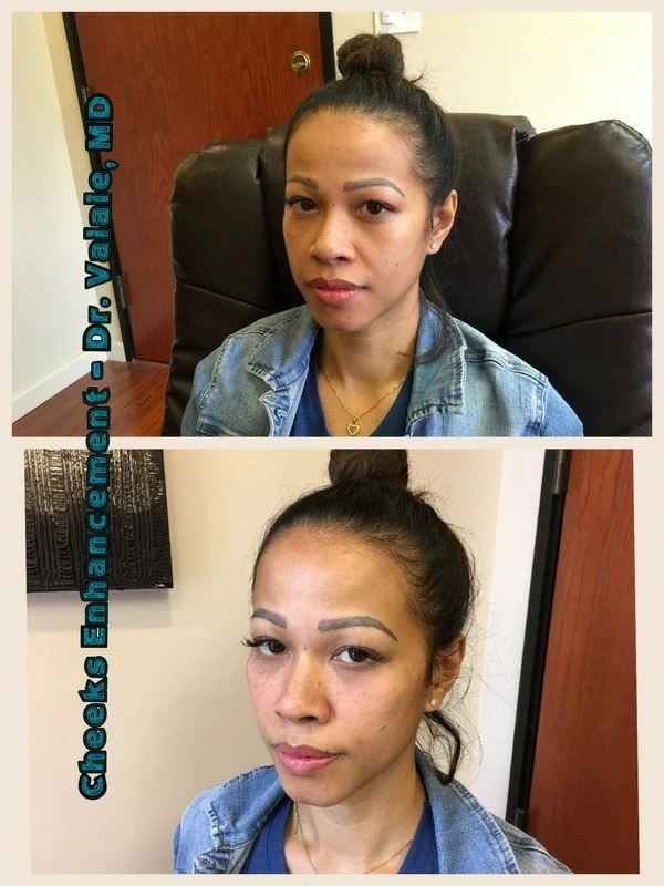 Cheek Augmentation Filler: Achieve Lifted, Sculpted Cheeks for a Youthful Look!