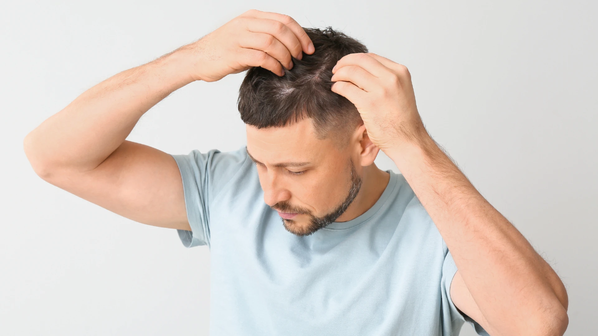Understanding the 3000 Grafts Hair Transplant Cost in India, Hair Transplant Cost in India, and PRP Hair Treatment In India: A Comprehensive Guide