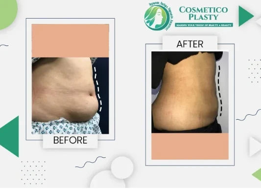 Best Hospitals for Liposuction in Lahore: A Comparison Guide