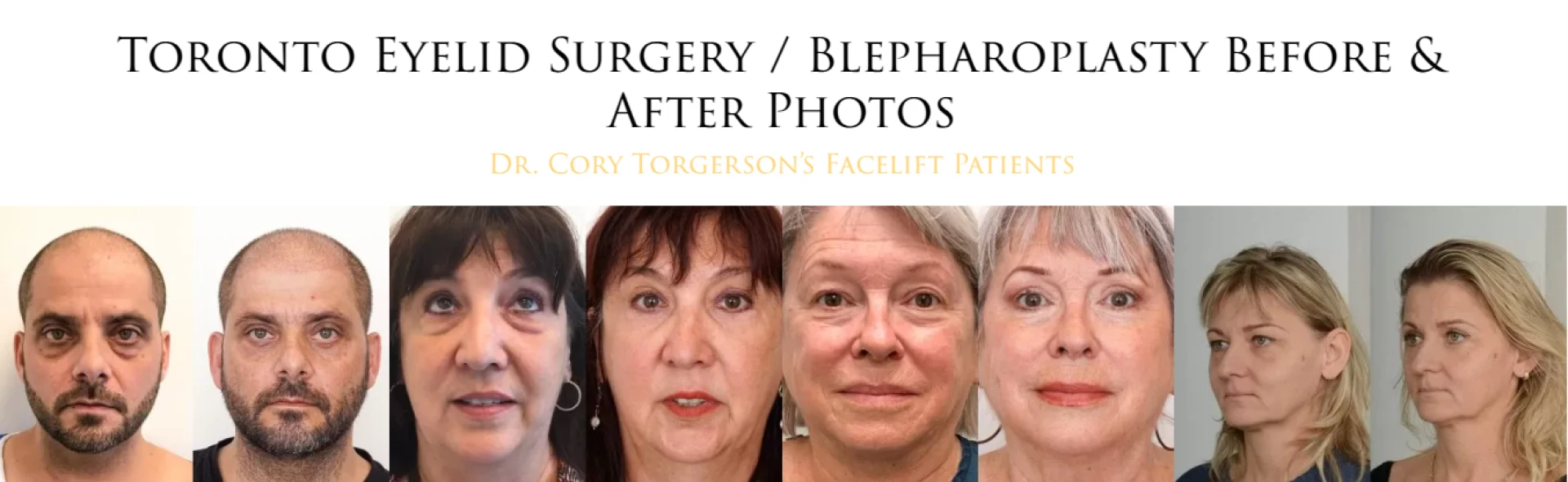 Rejuvenate Your Eyes with Blepharoplasty in Toronto: A Transformative Solution